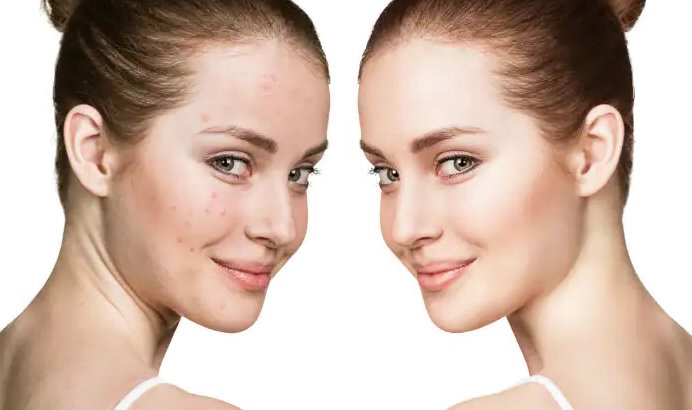 acne treatment