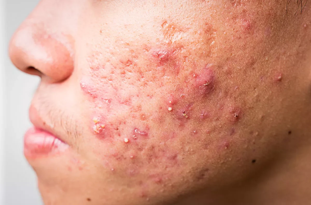 Best Acne Treatments, Remedies, And Side Effects