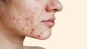 Acne treatment