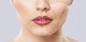 Will Drinking Water Help Acne