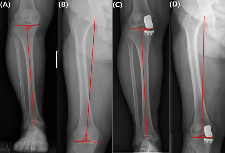 The Role of PACS in Knee