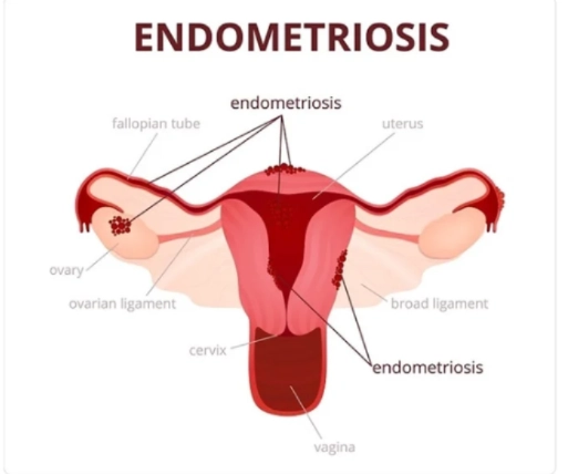 Endometriosis