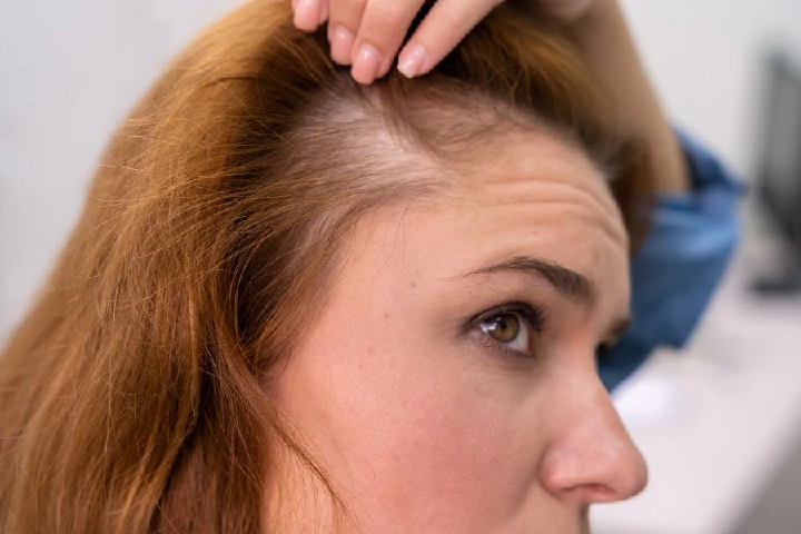 Hair Loss in Women: Causes, Solutions & Expert Advice