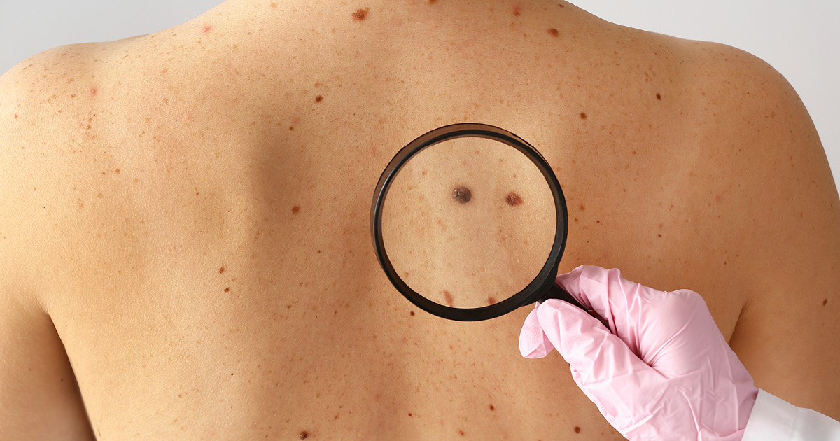 How To Address Skin Cancer