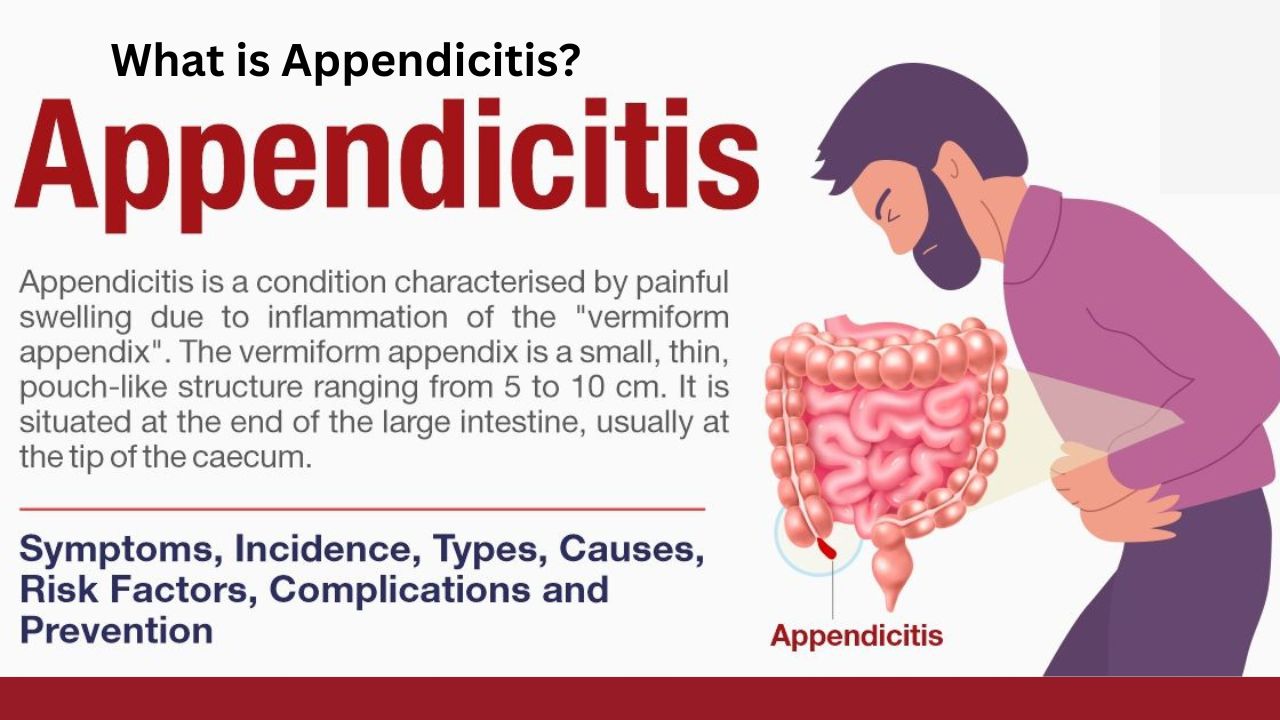 4 Stages Of Appendicitis