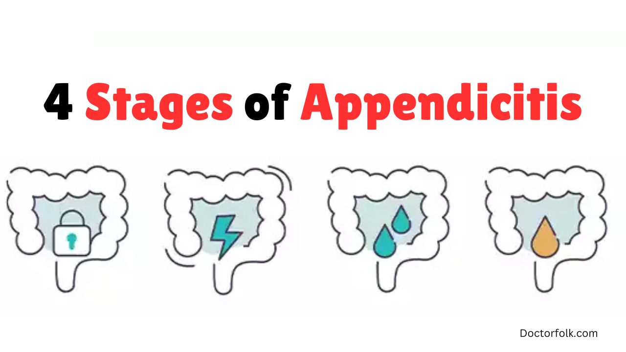 4 stages of appendicitis causes symptoms and treatment