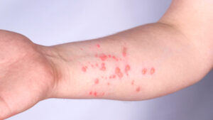 monkeypox rash pictures