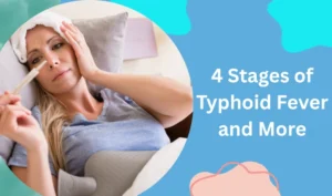 4 Stages of Typhoid Fever