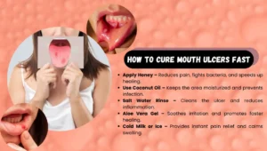 How to Cure Mouth Ulcers Fast Naturally