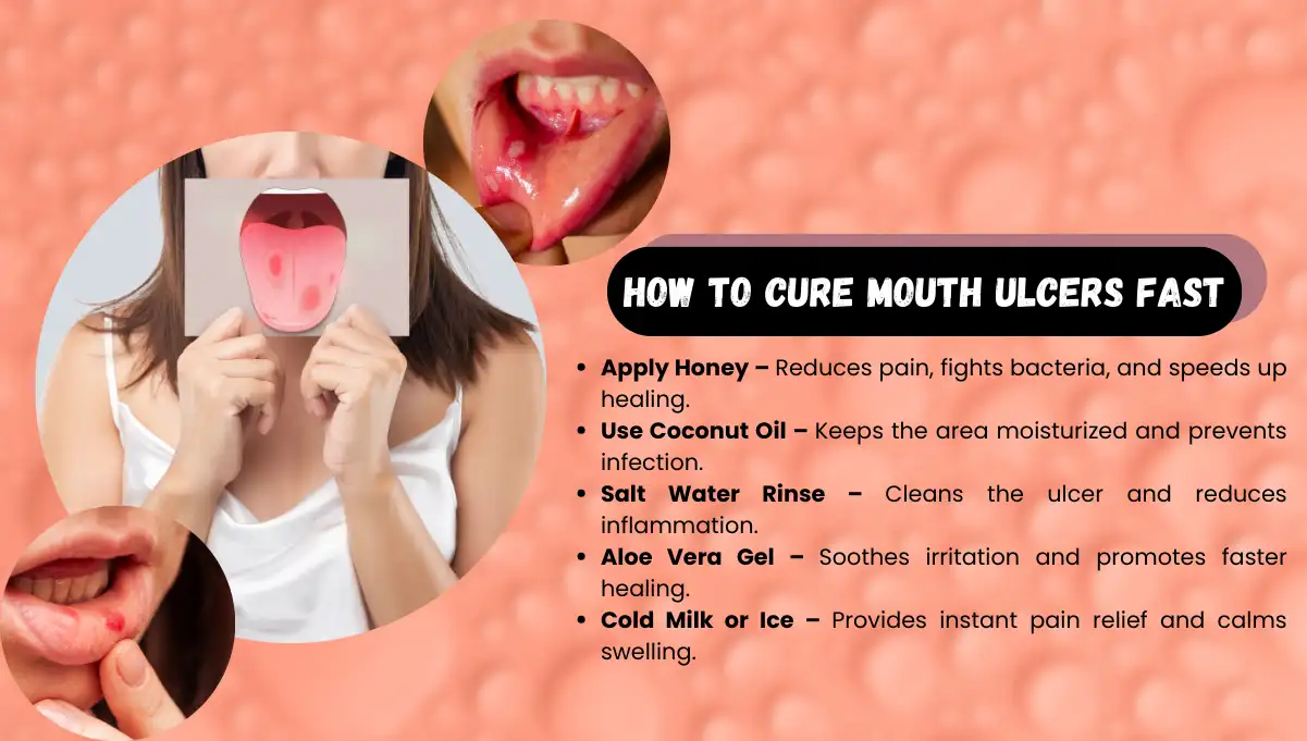 How to Cure Mouth Ulcers Fast Naturally At Home?