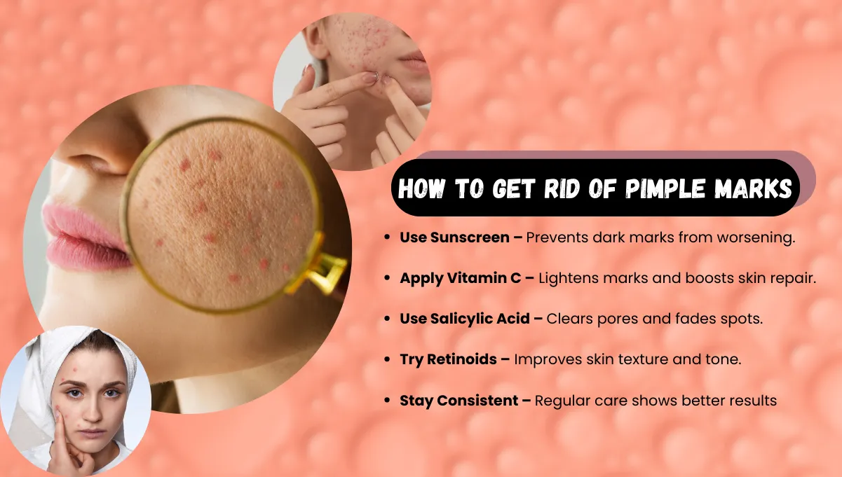 How to Get Rid of Pimple Marks