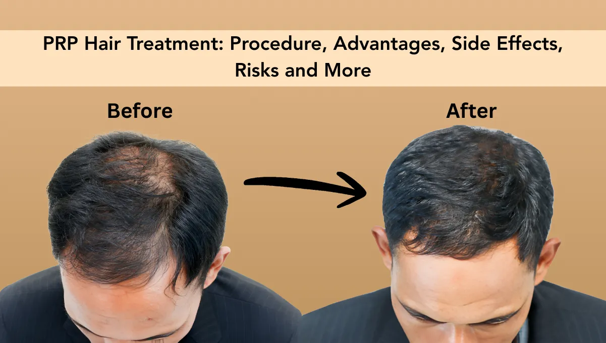 PRP Hair Treatment: Procedure, Advantages, Side Effects, Risks and More
