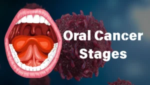 1st Oral Cancer Stages