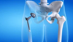 Hip Replacement Surgery