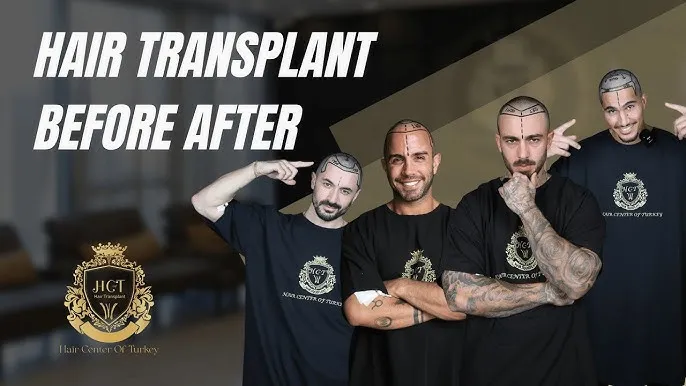 Top 10 Hair Transplant Clinics in Turkey 2026