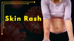 Skin Rash